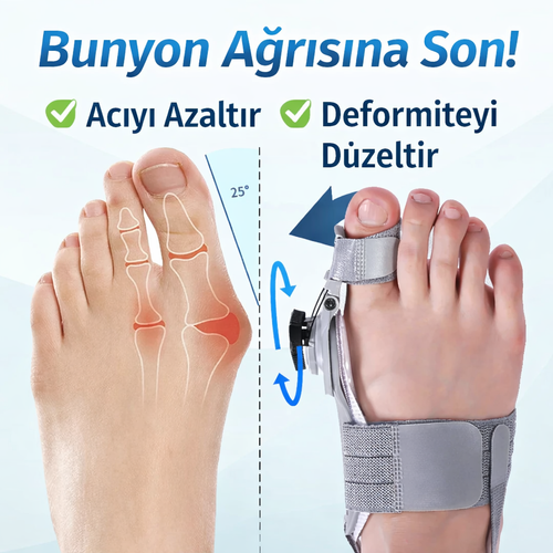 Ayak Başparmağı Çıkıntısı (Bunyon) Giderici